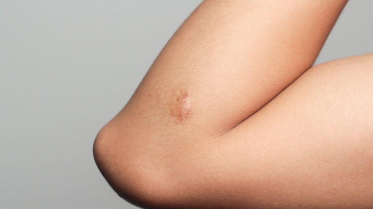 Keloid Nedir? Belirtileri ve Tedavi Yöntemleri