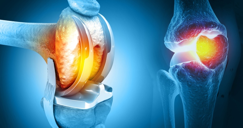 How is Knee Replacement Surgery Performed?