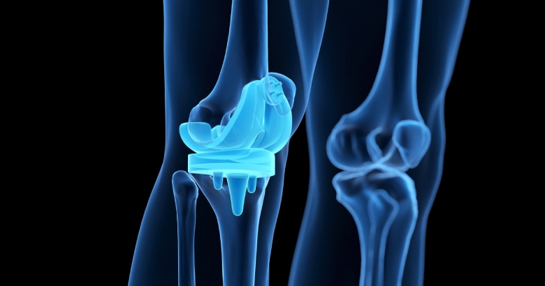 Who is a Good Candidate for Knee Replacement?