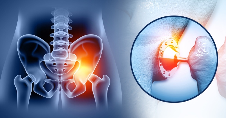 What is Hip Replacement?