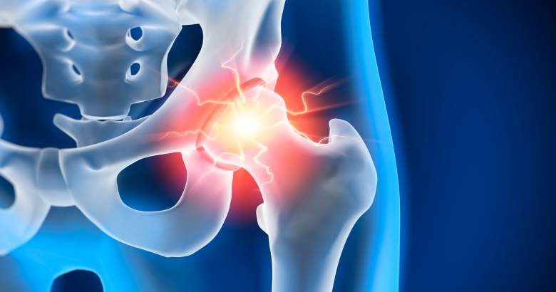 Who is a good candidate for hip replacement?